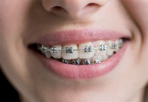 precios de brackets metalicos|cuanto cuestan los brackets.